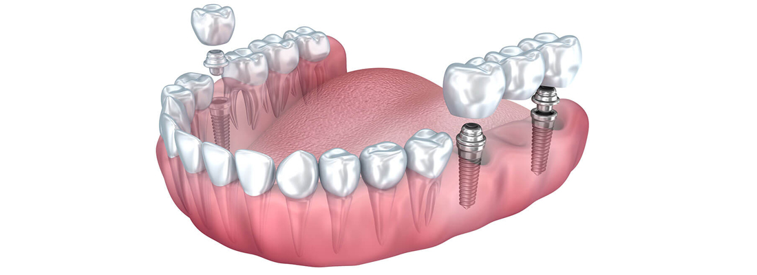 ایمپلنت دو دندان کنار هم یا بیشتر چگونه انجام می شود؟