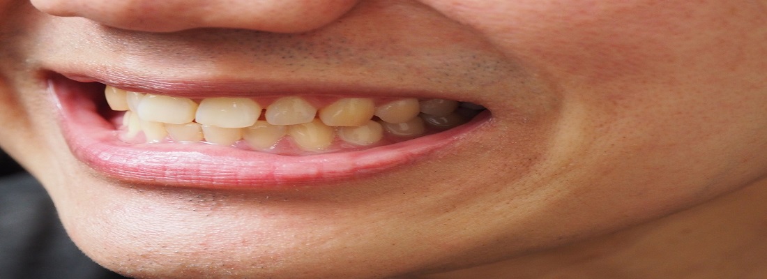 Teeth Discoloration and Stains
