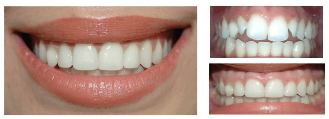 مزایای استفاده از باندینگ دندان
