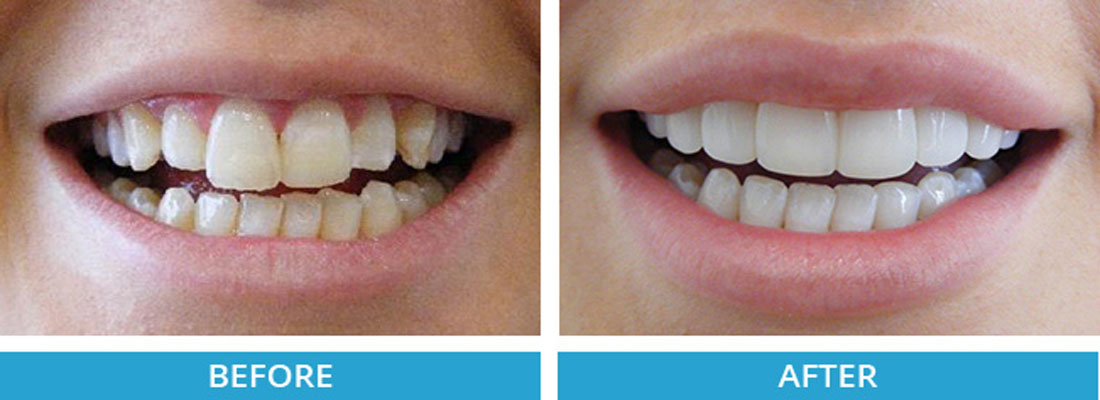 قبل و بعد از کامپوزیت دندان