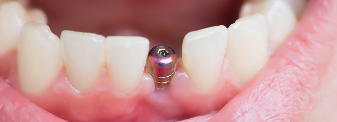 مراقبت های بعد از ایمپلنت دندان