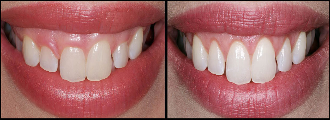 روش های افزایش طول تاج دندان