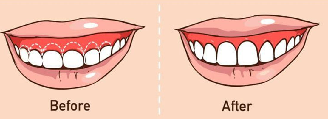 آشنایی با فرآیند افزایش طول تاج دندان