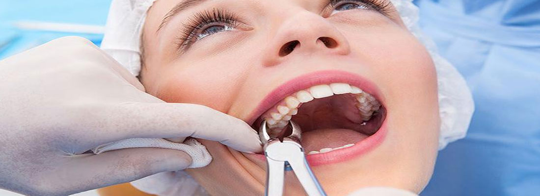دلایل کشیدن دندان