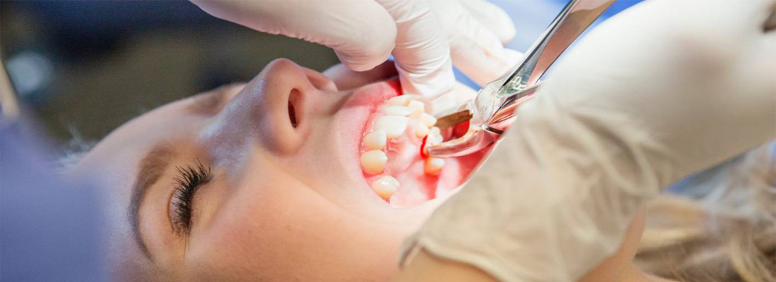 باز نشدن دهان بعد از جراحی دندان عقل