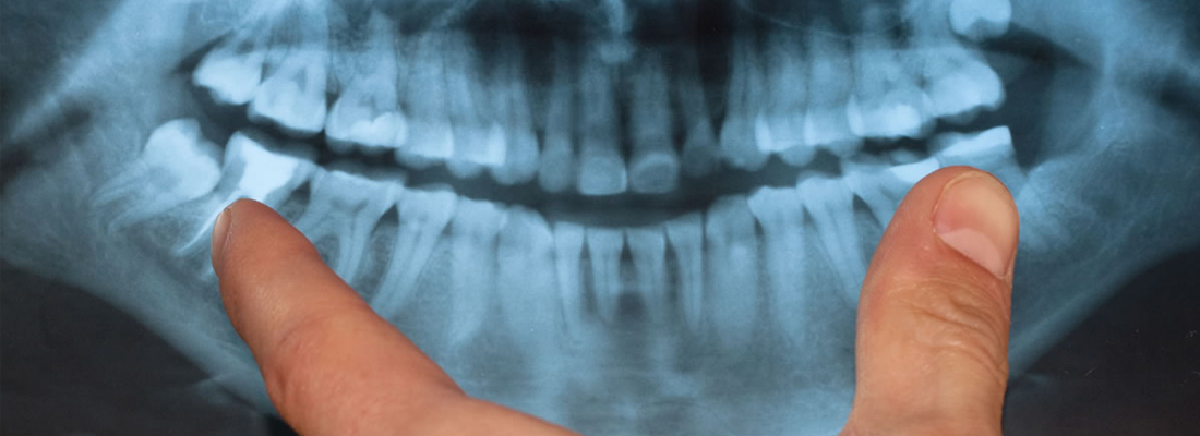 باز نشدن دهان بعد از جراحی دندان عقل