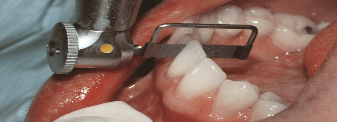 تراشیدن دندان در ارتودنسی