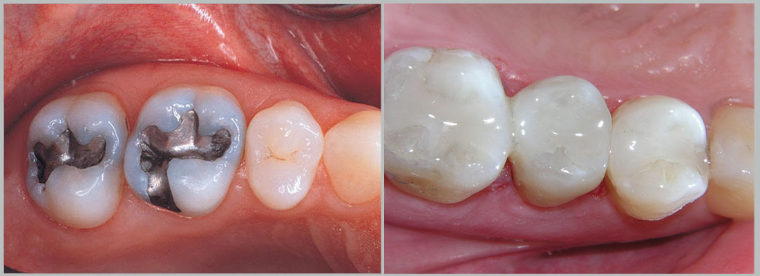 ترمیم دندان پرشده با آمالگام با استفاده از کامپوزیت