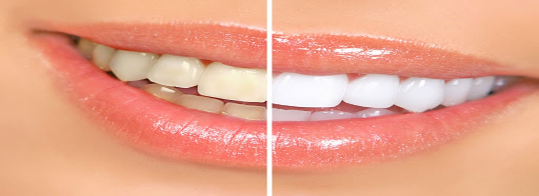نظرات کاربران درباره بلیچینگ دندان 