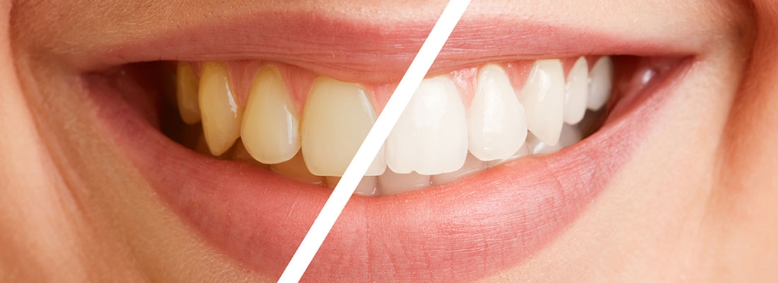 آیا جرم گیری دندان را سفید می کند