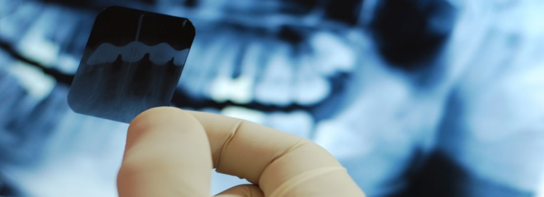 نحوه گرفتن عکس رادیوگرافی دندان