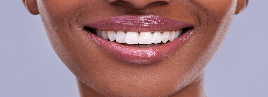 درمان پوسیدگی بین دو دندان جلو