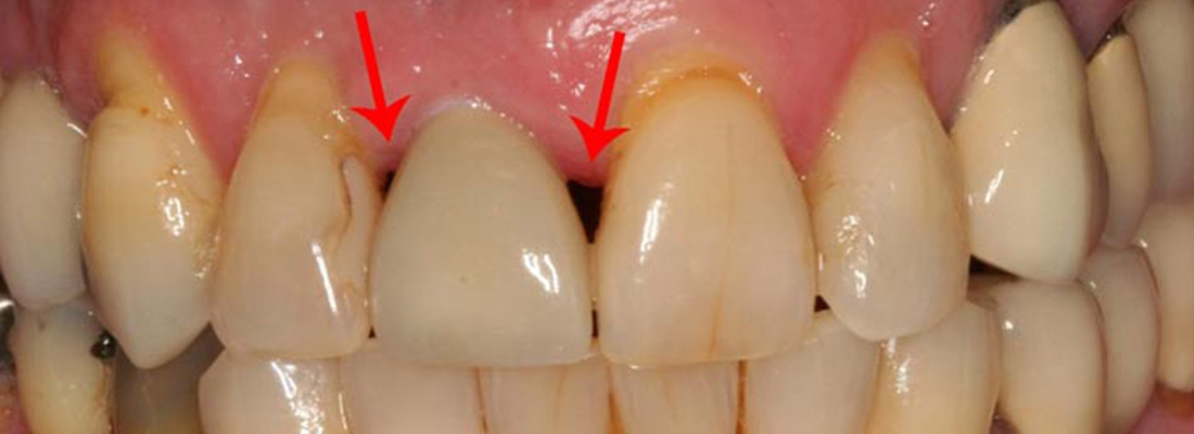 پوسیدگی بین دو دندان