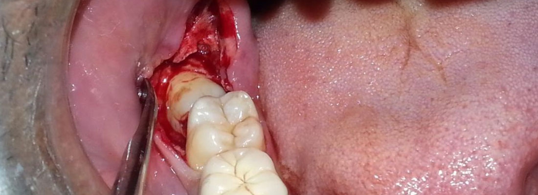 آیا جراحی دندان عقل مهم است؟