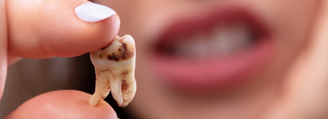 راه های درمان پوسیدگی دندان