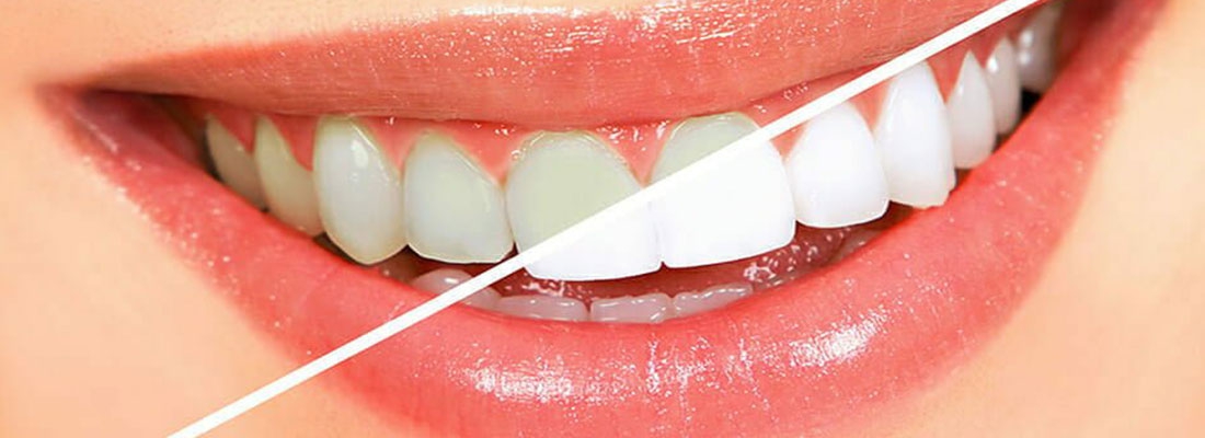 دندان ها را در خانه سفید کیند