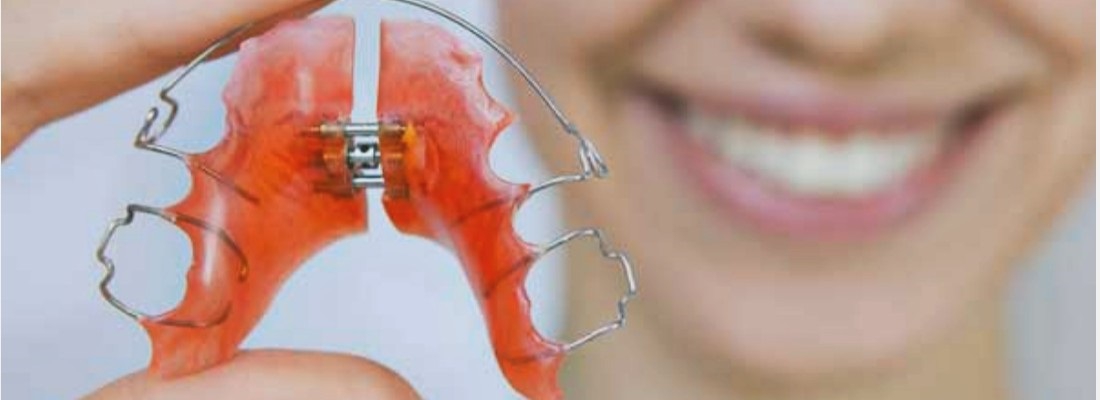 معرفی ارتودنسی متحرک دندان