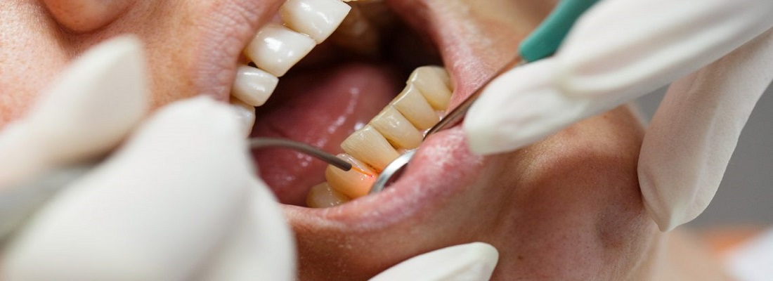 نحوه درمان پوسیدگی دندان با لیزر