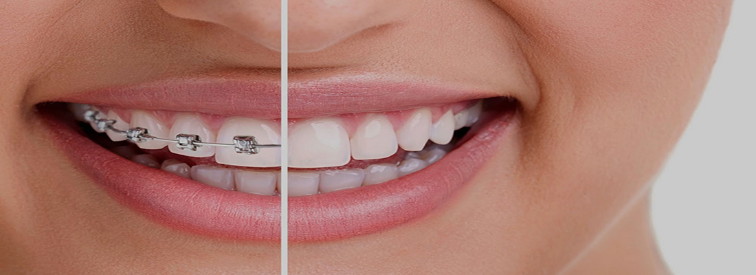 مراحل سیم کشی در دندان 