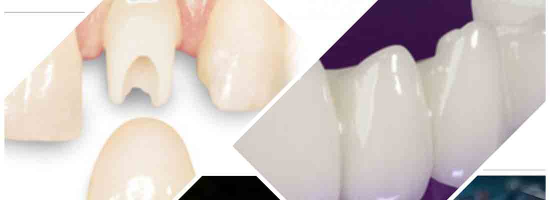 معرفی پروتز های دندان