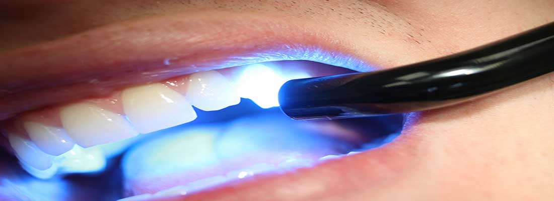 کاپوزیت دندان با لیزر