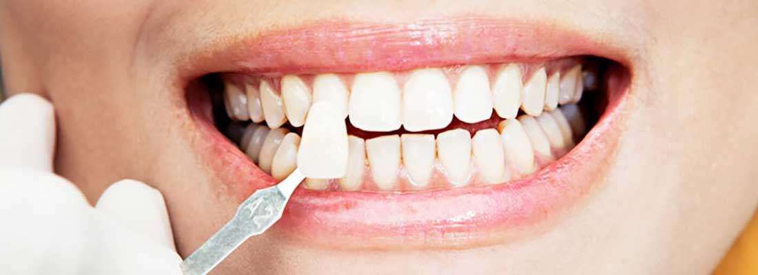 امروزه کامپوزیت دندان با مواد مختلفی انجام می شود