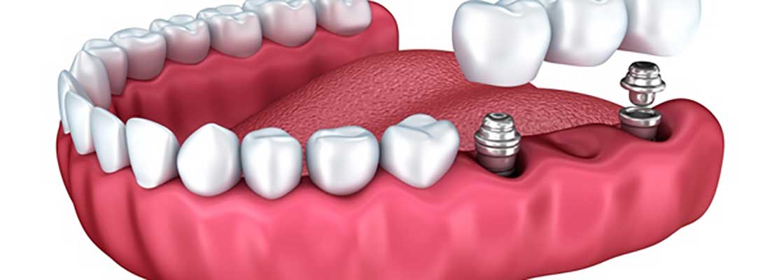 معایب های بریج دندانی 