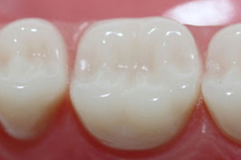 قیمت پرکردن دندان با مواد سفید