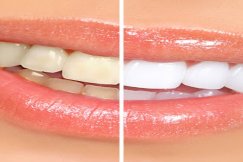 نظرات کاربران درباره بلیچینگ دندان 