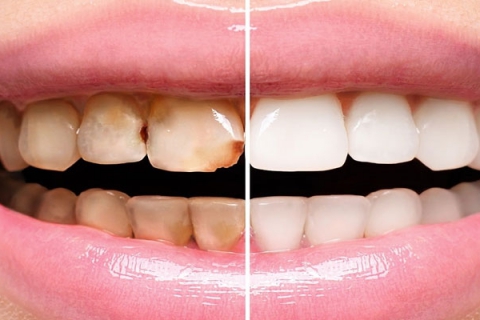 ترمیم دو سطحی دندان چیست
