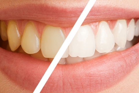 آیا جرم گیری دندان را سفید می کند