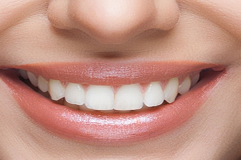 عوارض افزایش طول تاج دندان