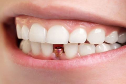 بهترین جایگزین دندان کشیده شده