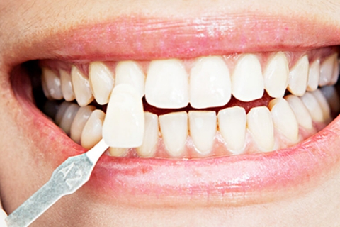 طول عمر کامپوزیت دندان 