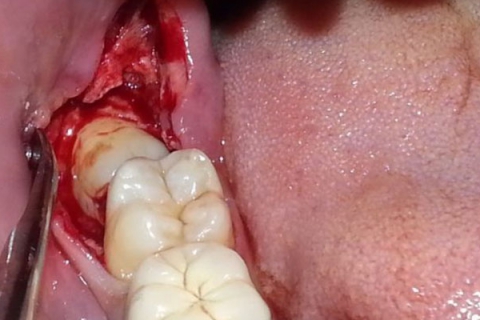 آیا جراحی دندان عقل مهم است؟