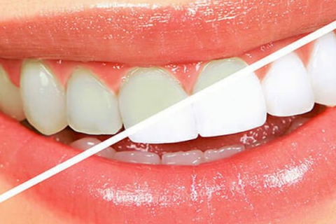دندان ها را در خانه سفید کیند