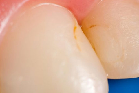 عوامل تاثیر گذار بر رنگ دندان