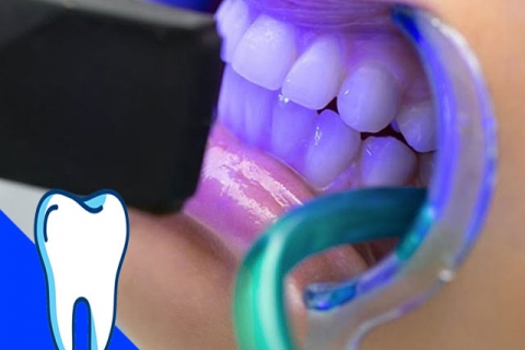 بلیچینگ دندان چگونه انجام میشود