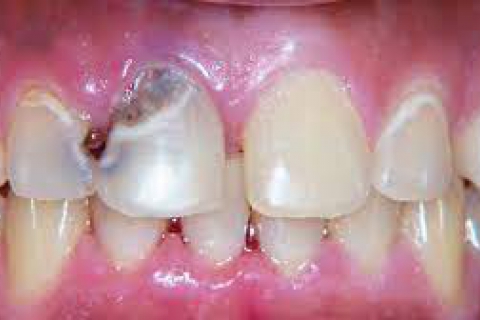 روش های جلوگیری از پوسیده شدن دندان ها 