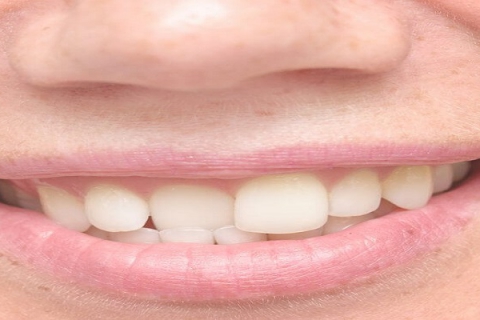 درمان دندان های نامرتب با کامپوزیت