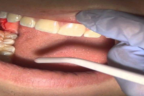 دلایل عفونت دندان