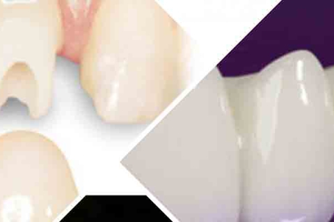 معرفی پروتز های دندان