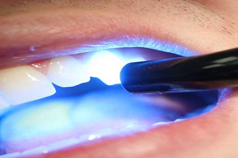 کاپوزیت دندان با لیزر