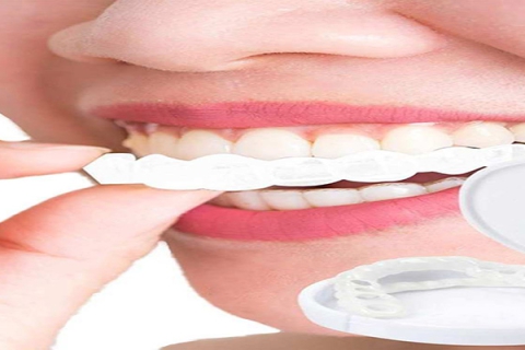 یک راه ترمیم ظاهر دندان استفاده از لمینت متحرک است