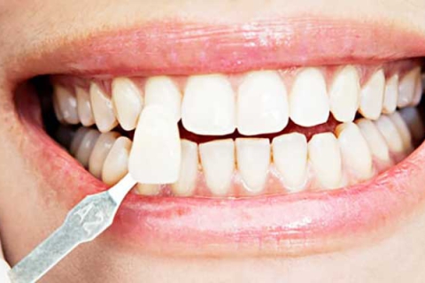 امروزه کامپوزیت دندان با مواد مختلفی انجام می شود