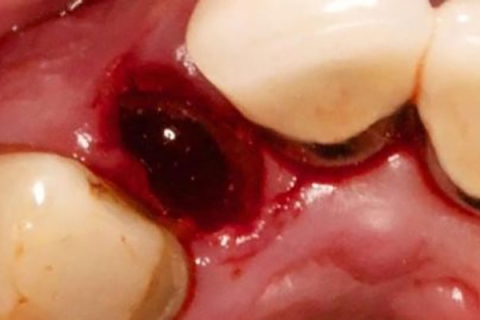 علائم عفونت دندان پس از کشیدن