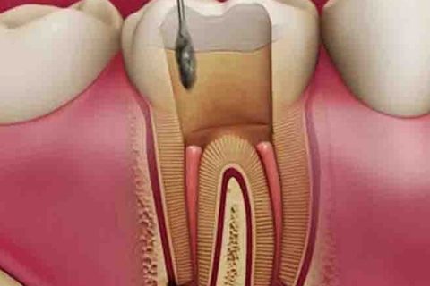 همه چیز در مورد ریشه دندان