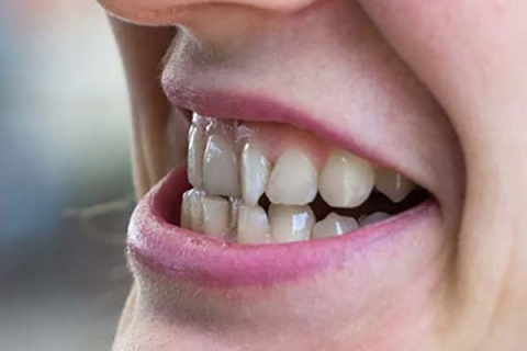 مال اکلوژن دندان چیست
