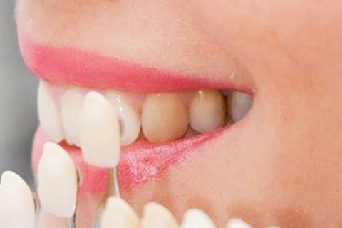 لمینیت دندان برای چه کسانی مناسب است؟