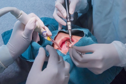 کاهش ورم صورت بعد از جراحی دندان